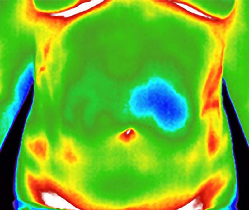 Can Thermography Help Women with Endometriosis?